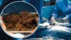 পেট থেকে বের হলো ২ কেজি ‘চুলের গোলা’