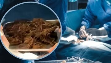 পেট থেকে বের হলো ২ কেজি ‘চুলের গোলা’