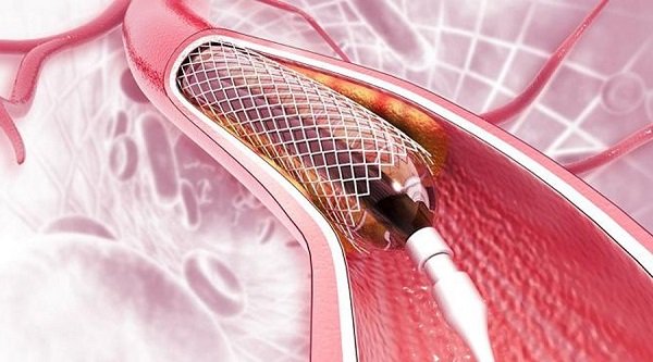 অক্টোবর থেকে হার্টের ১০ ধরনের রিংয়ের নতুন দাম কার্যকর