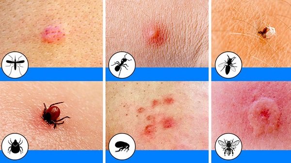 পোকা কামড়ের ঝুঁকি: কখন চিকিৎসকের কাছে যাবেন