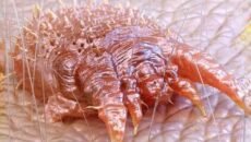 মানুষের চামড়ার নিচে ডিম পাড়ে স্ক্যাবিস লক্ষণ,কারণ, চিকিৎসা