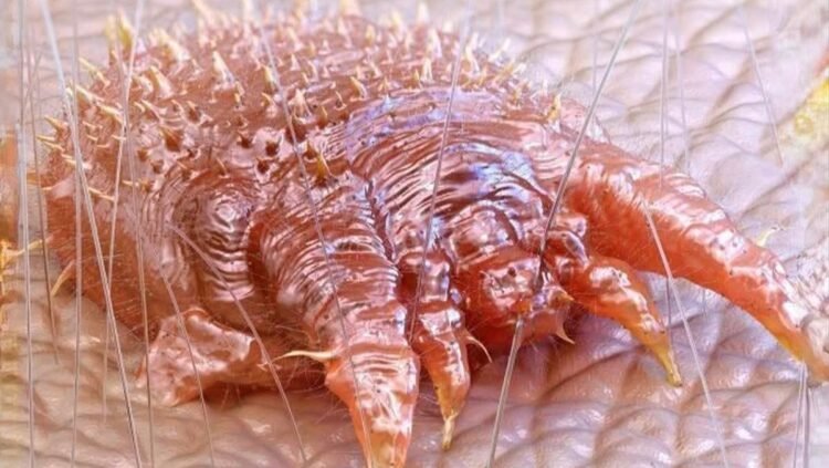 মানুষের চামড়ার নিচে ডিম পাড়ে স্ক্যাবিস লক্ষণ,কারণ, চিকিৎসা