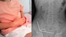 কিশোরের পেটে মিলল ১০০ শক্তিশালী চুম্বক