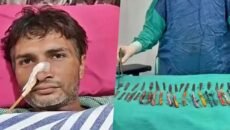 অস্ত্রোপচারে পেট থেকে বেরোল ২৯ চামচ, ১৯ টুথব্রাশ