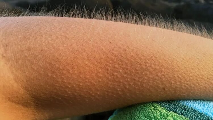 জেনে নিন ঠান্ডা লাগলে শরীরের লোম খাড়া হয় কেন